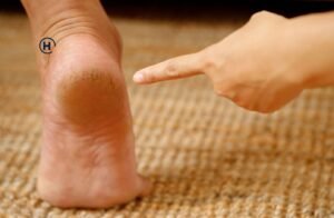Reason for Cracked Heels: Prevention & The Best Foot Care Cream